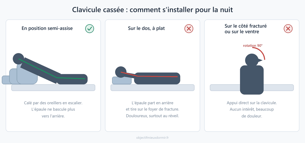 Clavicule cassée : les positions de sommeil qui soulagent et celles qui font mal