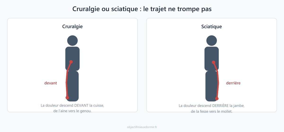 Cruralgie et sciatique : deux trajets de douleur opposés le long de la jambe