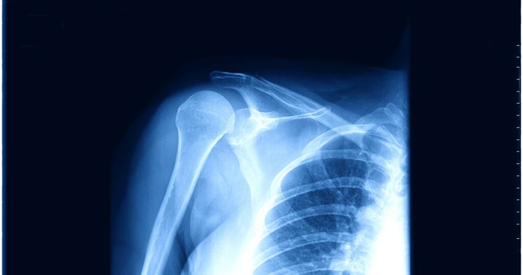Clavicule cassée : comment dormir sans réveiller la douleur