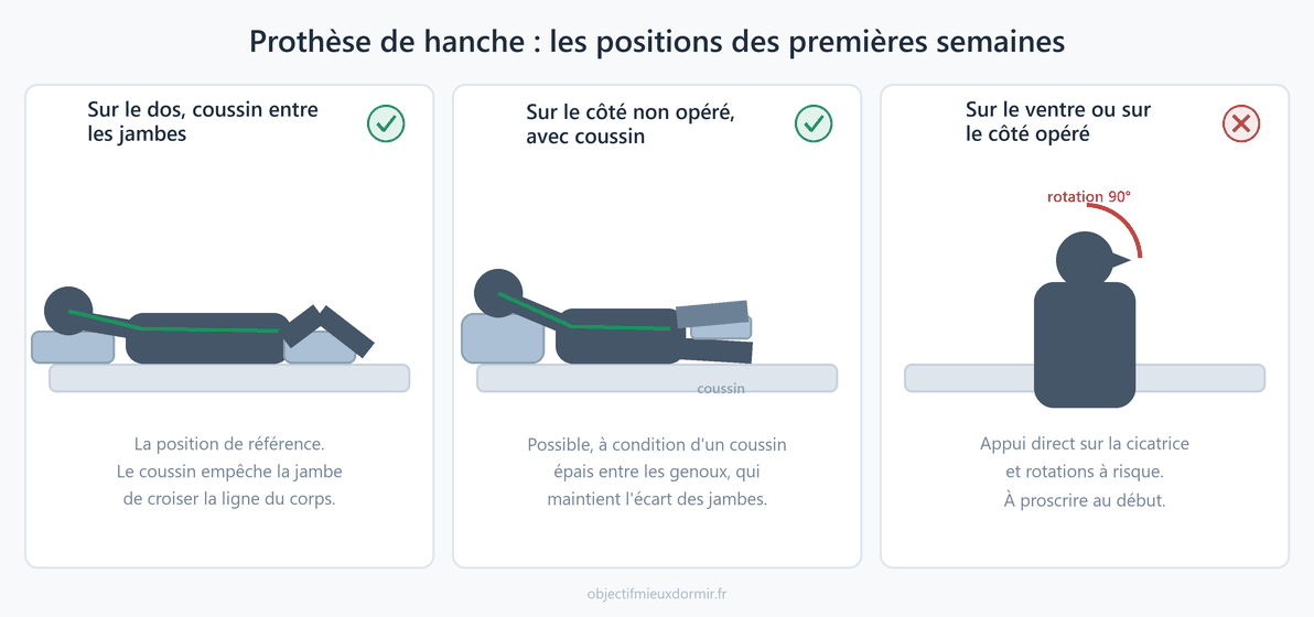 Prothèse de hanche : les positions de sommeil autorisées et celles à éviter